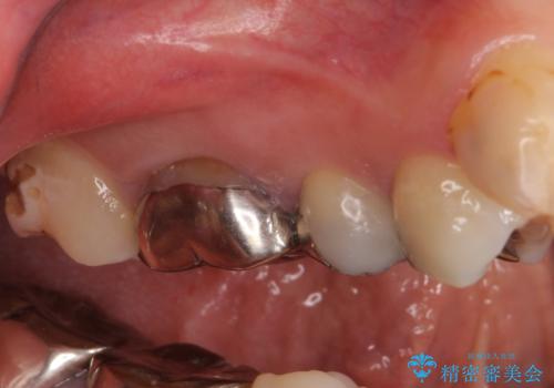 結婚式前に目立つ銀歯をセラミックにの治療前