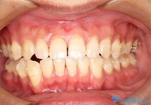 前歯がガタガタ インビザラインによる矯正の治療中