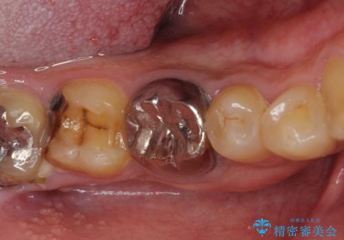骨の中にまで及んだ深い虫歯　歯周外科処置を用いた補綴治療の治療前