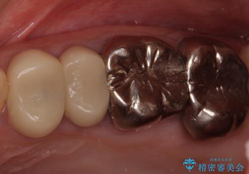 結婚式前に目立つ銀歯をセラミックにの治療前