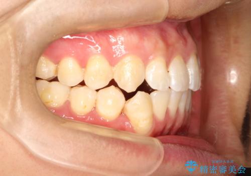 前歯がガタガタ インビザラインによる矯正の治療中