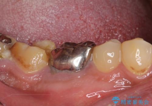 骨の中にまで及んだ深い虫歯 歯周外科処置を用いた補綴治療の治療前