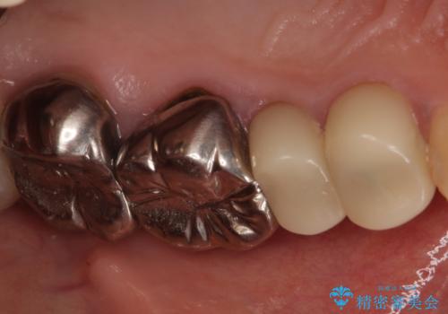 結婚式前に目立つ銀歯をセラミックにの治療前