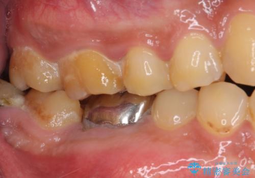 骨の中にまで及んだ深い虫歯　歯周外科処置を用いた補綴治療の治療前