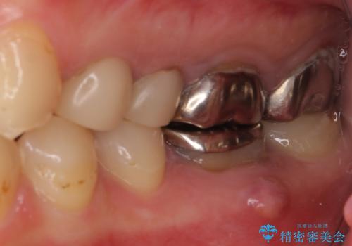 結婚式前に目立つ銀歯をセラミックにの治療前
