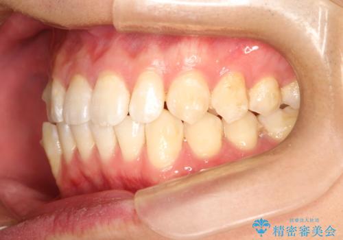 前歯がガタガタ インビザラインによる矯正の治療中