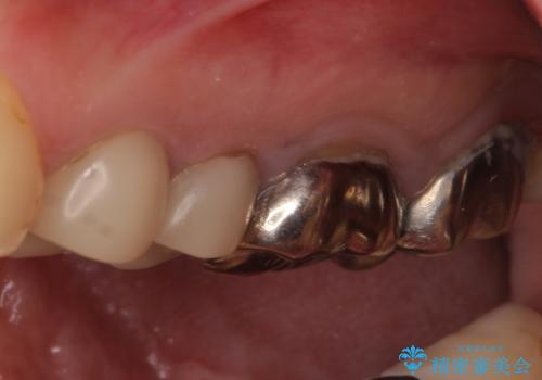 結婚式前に目立つ銀歯をセラミックにの治療前