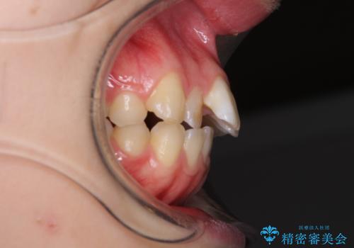 インプラント治療とインビザライン矯正治療 総合歯科治療の治療前