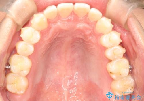 前歯がガタガタ　インビザラインによる矯正の治療中