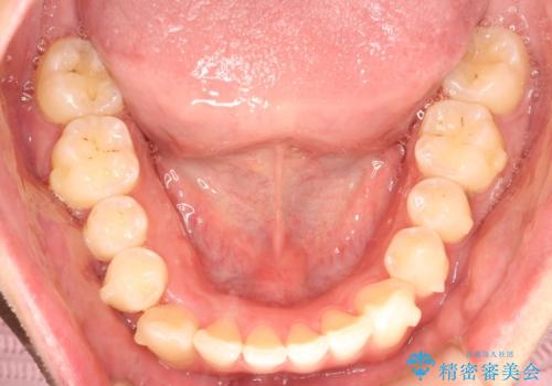 前歯がガタガタ　インビザラインによる矯正の治療中