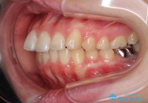 インプラント治療とインビザライン矯正治療　総合歯科治療の治療前