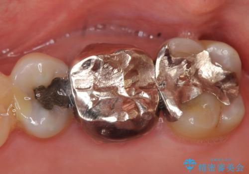 オールセラミッククラウン 口臭の原因であるフィステル(膿の出口)の治療の症例 治療前