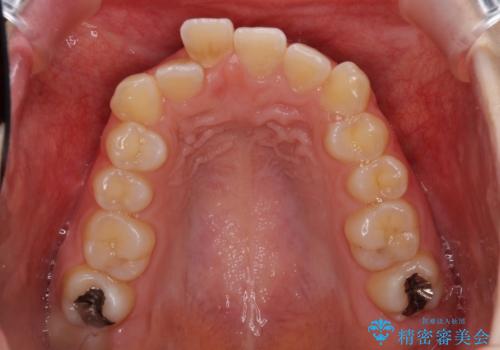 インプラント治療とインビザライン矯正治療 総合歯科治療の治療前