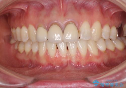 前歯の審美歯科治療 オールセラミッククラウンと部分矯正の治療前