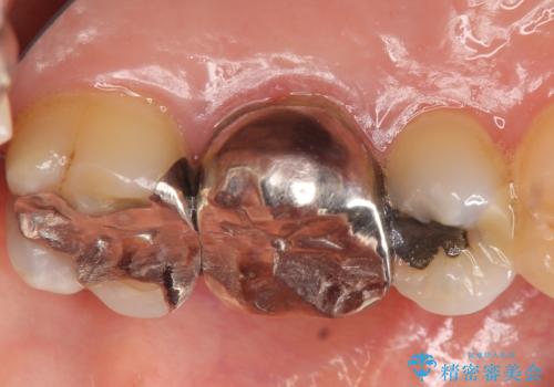 オールセラミッククラウン 口臭の原因であるフィステル(膿の出口)の治療の治療前