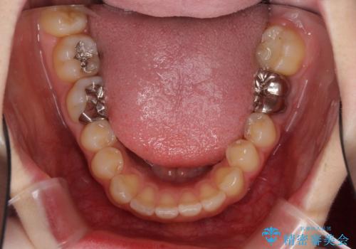 インプラント治療とインビザライン矯正治療 総合歯科治療の治療前