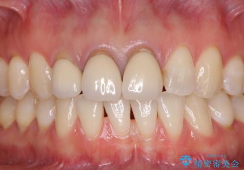 前歯の審美歯科治療　オールセラミッククラウンと部分矯正の症例 治療前