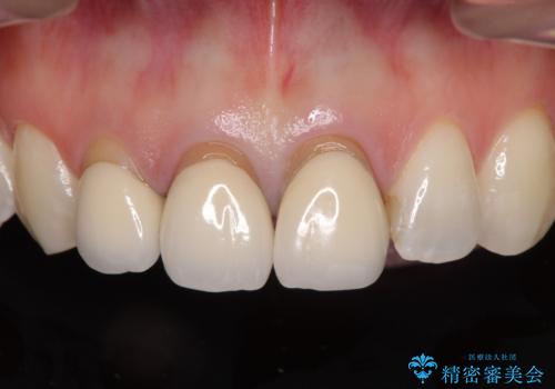 前歯の審美歯科治療 オールセラミッククラウンと部分矯正の治療前