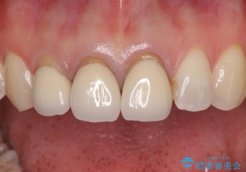 前歯の審美歯科治療 オールセラミッククラウンと部分矯正の治療前