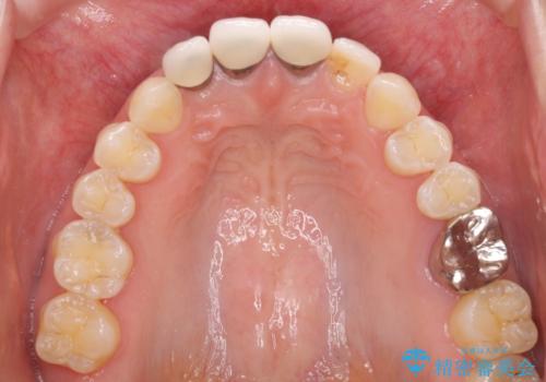 前歯の審美歯科治療　オールセラミッククラウンと部分矯正の治療前