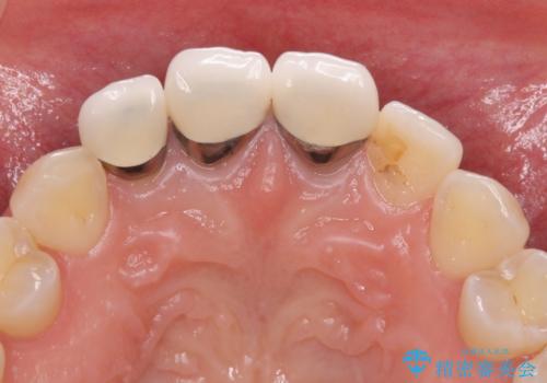 前歯の審美歯科治療　オールセラミッククラウンと部分矯正の治療前