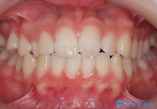 前歯のがたつき　乳歯を抜かずに矯正の症例 治療前