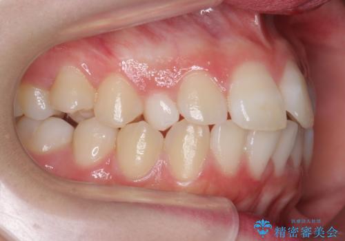 前歯のがたつき　乳歯を抜かずに矯正の治療前
