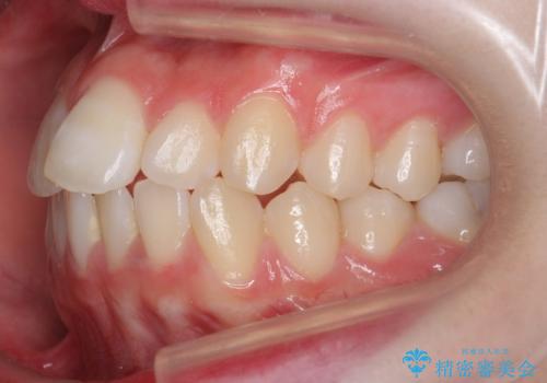 前歯のがたつき 乳歯を抜かずに矯正の治療前