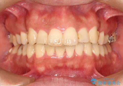 出っ歯の抜歯矯正 裏側ワイヤーによる目立たない矯正の治療中