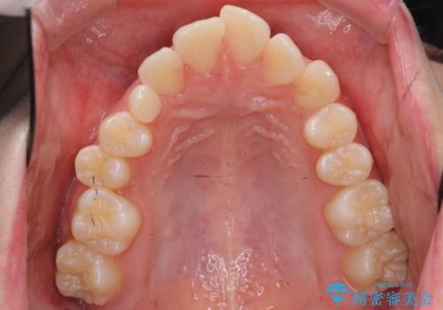 前歯のがたつき 乳歯を抜かずに矯正の治療前