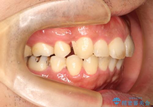 出っ歯の抜歯矯正　裏側ワイヤーによる目立たない矯正の治療中