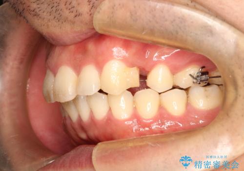 出っ歯の抜歯矯正 裏側ワイヤーによる目立たない矯正の治療中