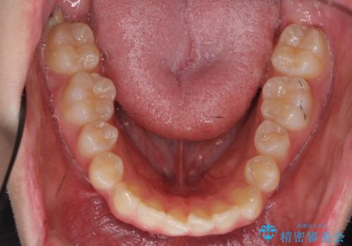 前歯のがたつき 乳歯を抜かずに矯正の治療前