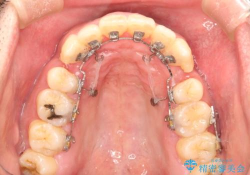 出っ歯の抜歯矯正　裏側ワイヤーによる目立たない矯正の治療中
