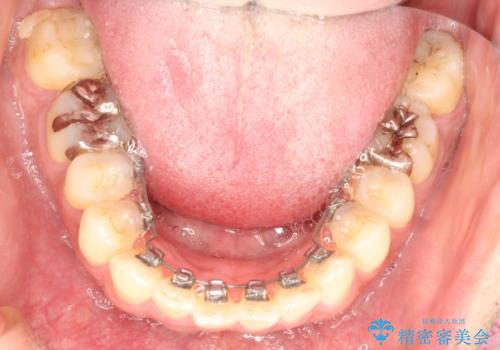 出っ歯の抜歯矯正 裏側ワイヤーによる目立たない矯正の治療中