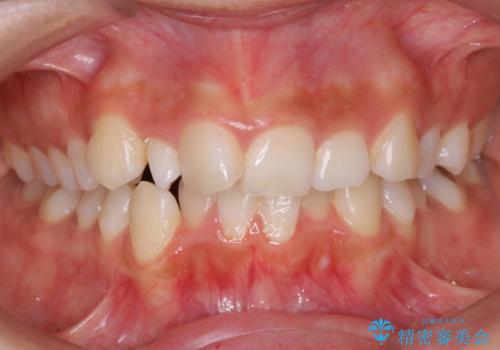 前歯のがたつき・出っ歯　ワイヤーによる抜歯矯正の治療前