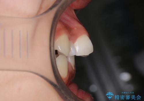 前歯のがたつき・出っ歯 ワイヤーによる抜歯矯正の治療前