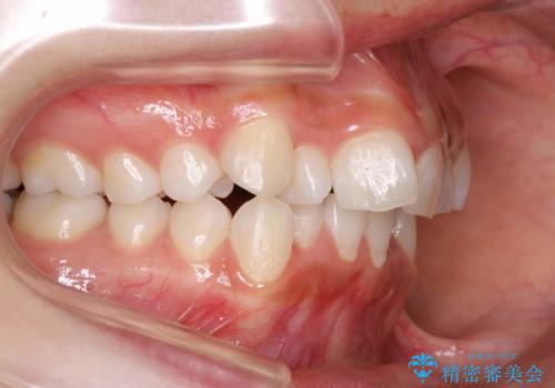 前歯のがたつき・出っ歯 ワイヤーによる抜歯矯正の症例 治療前