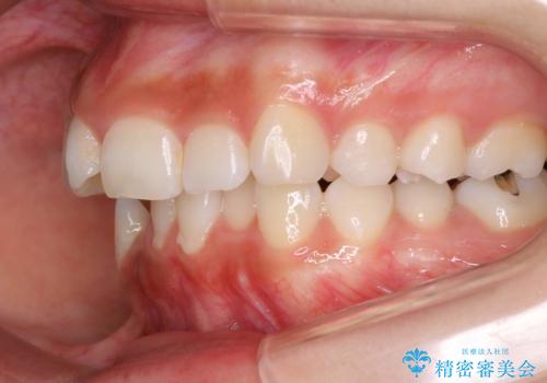 前歯のがたつき・出っ歯 ワイヤーによる抜歯矯正の治療前
