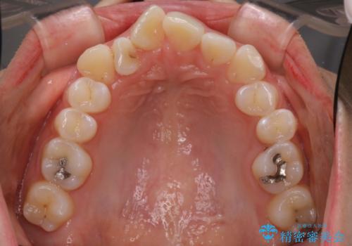 前歯のがたつき・出っ歯　ワイヤーによる抜歯矯正の治療前