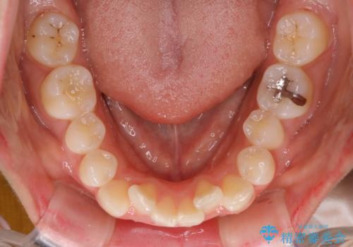 前歯のがたつき・出っ歯 ワイヤーによる抜歯矯正の治療前