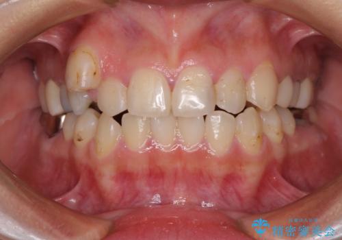 結婚式前に目立つ銀歯をセラミックにの症例 治療後