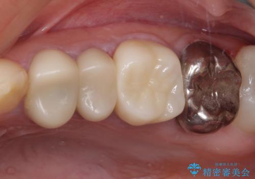 結婚式前に目立つ銀歯をセラミックにの治療後