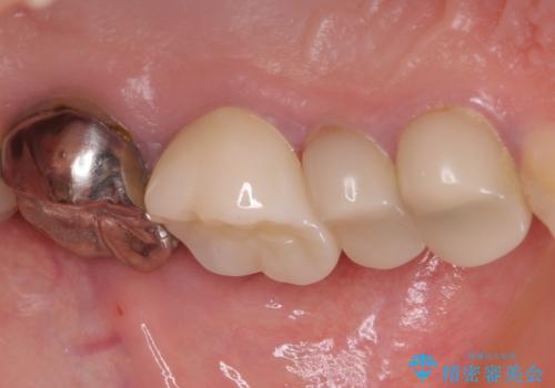 結婚式前に目立つ銀歯をセラミックにの治療後