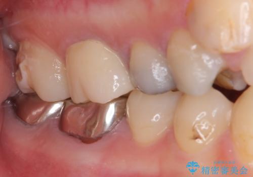 結婚式前に目立つ銀歯をセラミックにの治療後