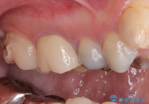 結婚式前に目立つ銀歯をセラミックにの治療後