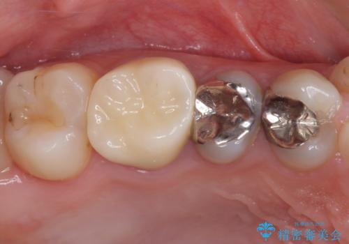 結婚式前に目立つ銀歯をセラミックにの治療後