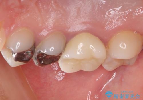 結婚式前に目立つ銀歯をセラミックにの治療後