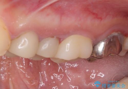 結婚式前に目立つ銀歯をセラミックにの治療後