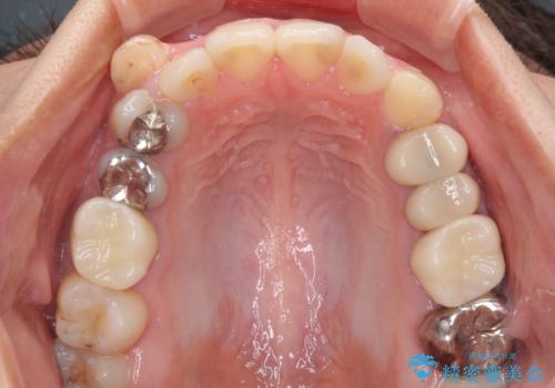 結婚式前に目立つ銀歯をセラミックにの治療後